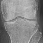 Knee-e1589885895425-150x150