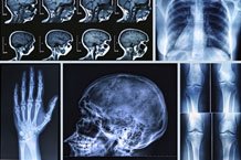 MRI